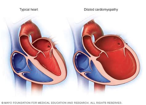 non dilated left ventricle meaning.